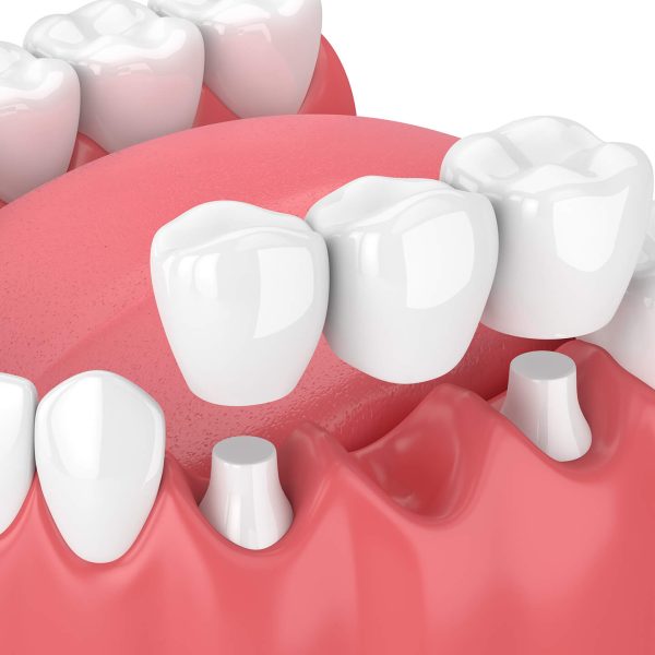 Dental Bridges