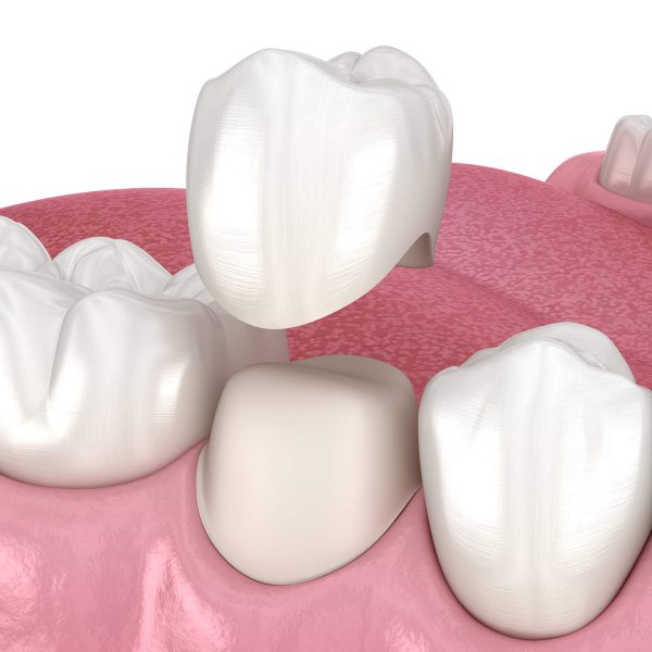 Dental Crowns